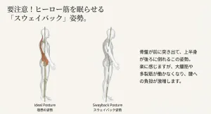 鹿児島 腰痛 姿勢改善 スウェイバックと理想的な姿勢の比較図